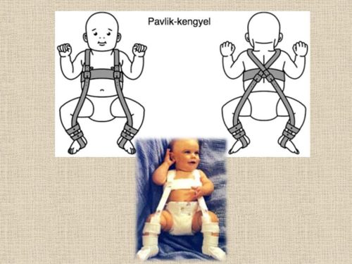 Pavlik-kengyel ppf630 0 prima protetika