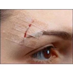   Steri-strip 6 x 100 mm bőrzáró csík 10 db csík/ív (3 m)